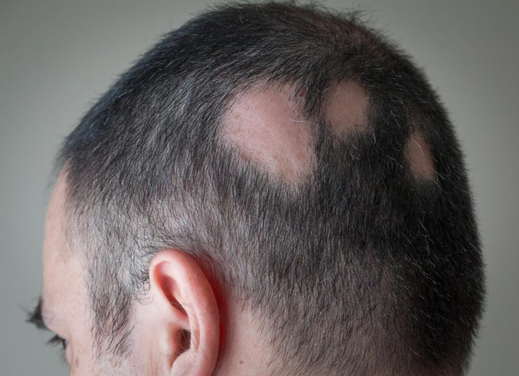 alopecia universalis treatment 2015 alopecia universalis treatment 2015
